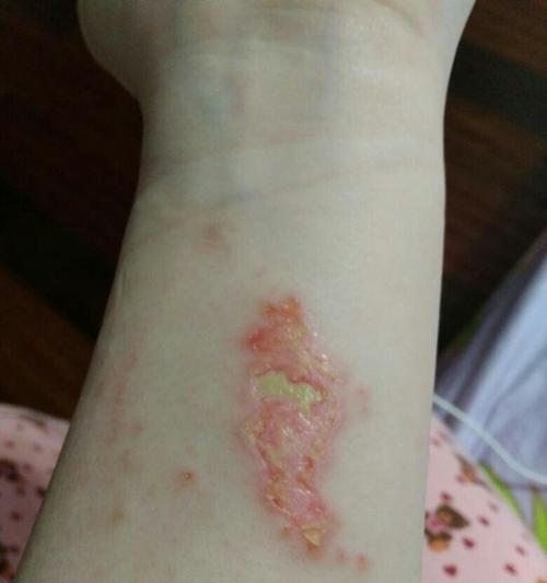 烫伤急救方法（掌握正确处理技巧）  第1张