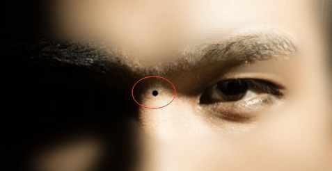 人身上长痣是什么原因？痣的形成与哪些因素有关？  第1张