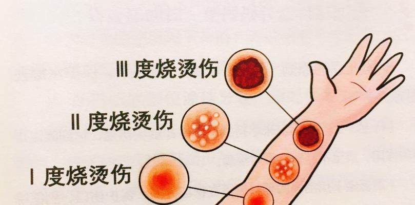 被烫伤后家庭急救措施有哪些？如何正确处理烫伤？  第3张